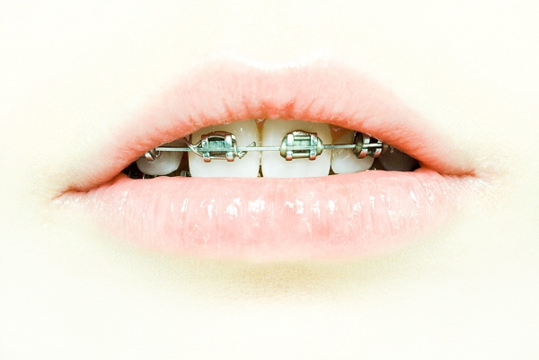 Orthodontics_for_adults