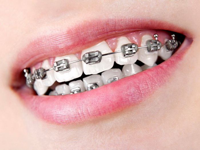 10 Argumente für die Zahnregulierung in Ungarn