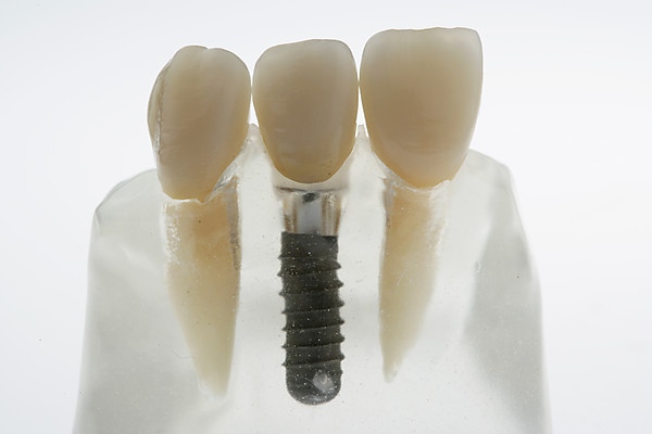 implantátum