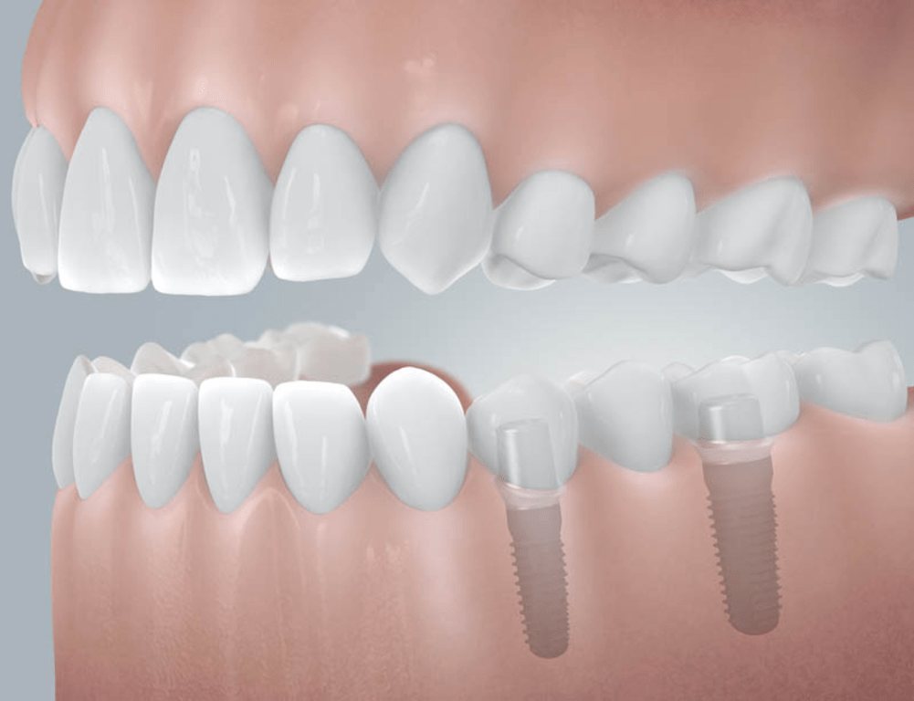 Die 5 größten Vorteile von ComFOUR Implantaten