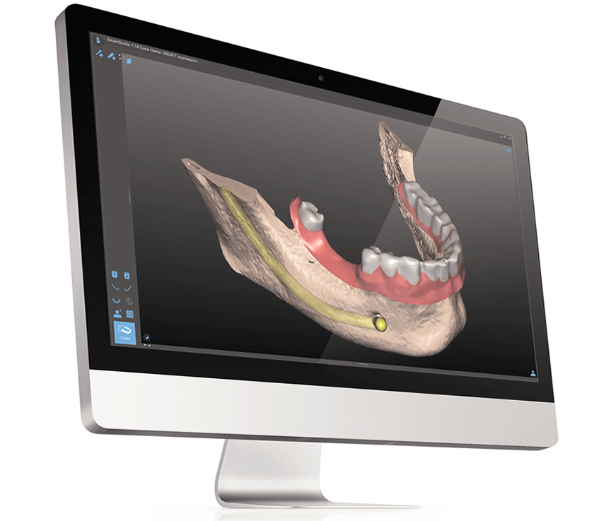 Die modernste Form für Zahnersatz ist erreichbar – die revolutionäre SMART Guide Technologie in der Hillside Dental Zahnklinik